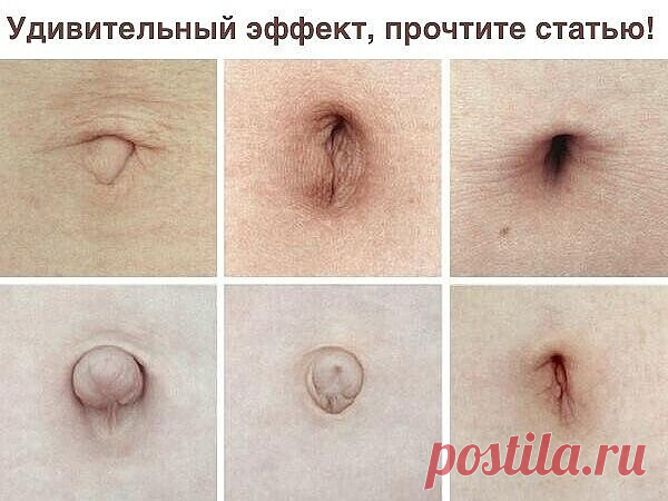 Вы знали, зачем смазывать пупок маслом?

В моей практике был один запоминающийся случай, после которого, я аспирант тогдашнего Ленинградского мединститута, стал собирать всю информацию и печатную, и устную, от других коллег и своих пациентов, об этом важном отделе нашего тела 