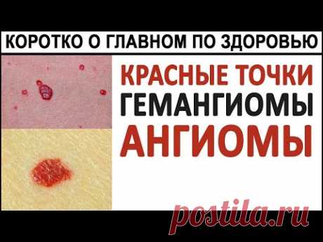Красные точки на теле. Гемангиомы. Ангиомы. Что делать с красными точками на КОЖЕ?