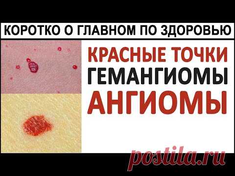 Красные точки на теле. Гемангиомы. Ангиомы. Что делать с красными точками на КОЖЕ?