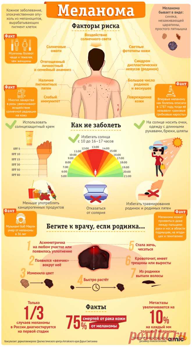 Кто и как может заболеть смертельным кожным раком - меланомой