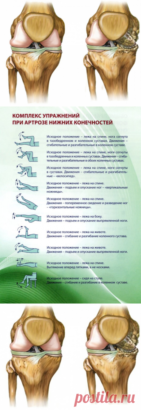 Артроз нижних конечностей, симптоматика, рецепты народной медицины, комплекс упражнений при артрозе нижних конечностей