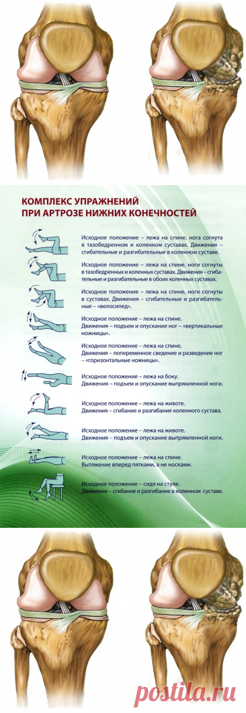 Артроз нижних конечностей, симптоматика, рецепты народной медицины, комплекс упражнений при артрозе нижних конечностей