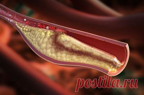 Бомба из тромба. Как предотвратить внезапную смерть | Здоровая жизнь | Здоровье | Аргументы и Факты