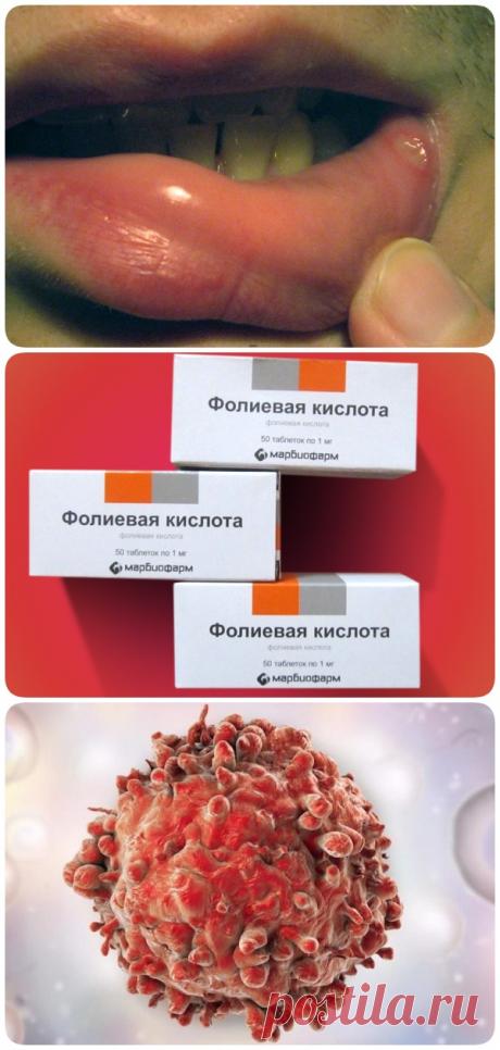 Умственная отсталость, рост раковых клеток, ранняя седина и стоматит… С фолиевой кислотой не шутят! - interesno.win