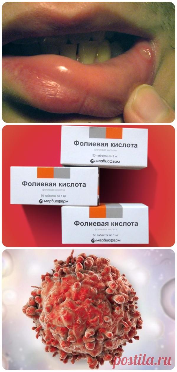 Умственная отсталость, рост раковых клеток, ранняя седина и стоматит… С фолиевой кислотой не шутят! - interesno.win