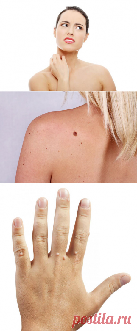 Простой способ избавления от родинок, бородавок, папиллом и возрастных пятен — Всегда в форме!