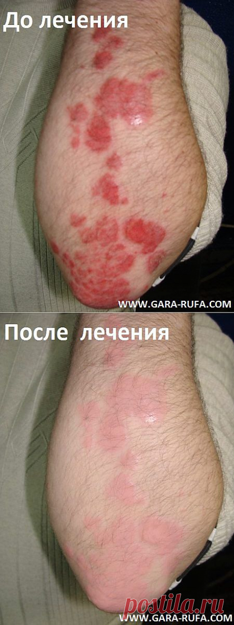 Лечение кожных заболеваний рыбой-доктором Гарра Руфа(Garra Rufa).Рекомендации и противопоказания.