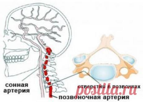 Гипертония при синдроме шейных артерий. Лечение | Советы целительницы