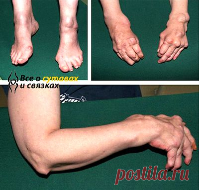 Ревматоидный полиартрит: лечение, симптомы и причины