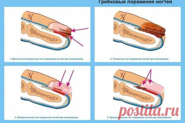 Как вылечить грибок на ногтях?Будем здоровы!