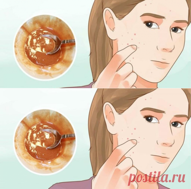 Эта маска для лица естественно удаляет пятна, шрамы от угревой сыпи и морщины после второго использования - Советы для тебя - Полезные советы
Просматривайте этот и другие пины на доске Красота пользователя Irina.
Теги
Эта маска для лица действительно удаляет пятна и шрамы от угрей и морщин после первого применения
Что говорят другие
Красивая попа.
5 эффективных упражнений