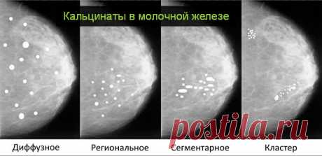 Кальцинаты в молочной железе: причины, диагностика, лечение