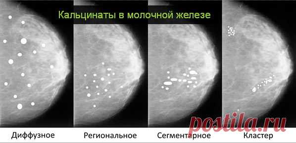 Кальцинаты в молочной железе: причины, диагностика, лечение