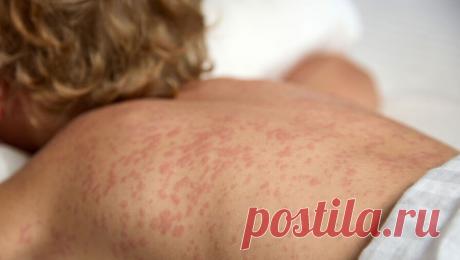 Пик заболеваемости корью в РФ был в марте, с апреля она снижается. С начала апреля в России наблюдается уменьшение числа случаев заражения корью после всплеска заболеваемости в марте. Об этом сообщает Роспотребнадзор. По данным ведомства, это связано с проведением иммунизации мигрантов, что делает Россию ...