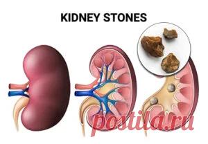8 простых способов очистить почки