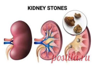8 простых способов очистить почки