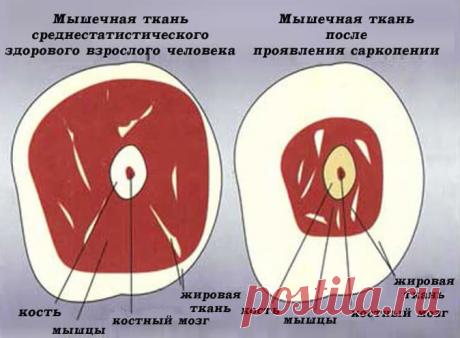 Узнайте, не грозит ли вам САРКОПЕНИЯ?
