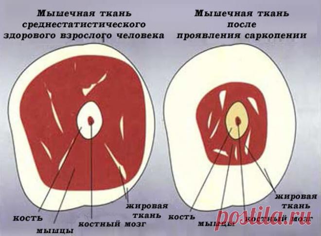 Узнайте, не грозит ли вам САРКОПЕНИЯ?