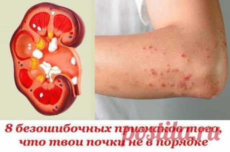 Признаки болезни почек 

 
Эти жизненно важные органы расположены по бокам от позвоночника в поясничной области. От исправной работы почек зависит многое: состояние кожи, самочувствие, минеральный баланс в организме, количе…