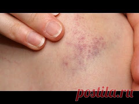 Подорожник – от ушибов помощник | Друг пенсионера