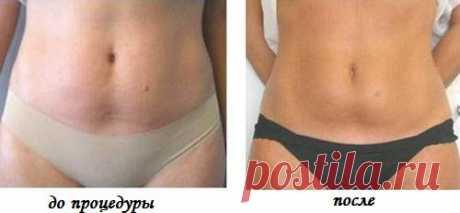 В начале своего похудения я не была толстой, но у меня был жуткий-некрасивый живот. Самая сложная и проблемная часть тела. Нашла я выход и сейчас довольствуюсь результатом.
Соблюдая мою инструкцию вы справитесь с такой проблемой за 10 дней. Хватит ходить с некрасивым животом, пора заняться собой. Грубо? Я давала себе такую мотивацию!