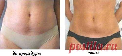 В начале своего похудения я не была толстой, но у меня был жуткий-некрасивый живот. Самая сложная и проблемная часть тела. Нашла я выход и сейчас довольствуюсь результатом.
Соблюдая мою инструкцию вы справитесь с такой проблемой за 10 дней. Хватит ходить с некрасивым животом, пора заняться собой. Грубо? Я давала себе такую мотивацию!