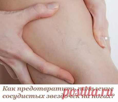 Как предотвратить появление сосудистых звездочек на ногах?