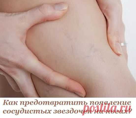 Как предотвратить появление сосудистых звездочек на ногах?