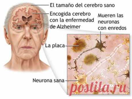 5 consejos para prevenir la enfermedad de Alzheimer - Mejor Con Salud
