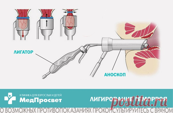 Лечение геморроя 2-3 стадии при помощи лигирования латексными кольцами.

Геморрой - заболевание, связанное с расширением вен прямой кишки, приводящее к образованию геморроидальных узлов, которые могут воспаляться, кровоточить, осложняться тромбозом.
Показать полностью...