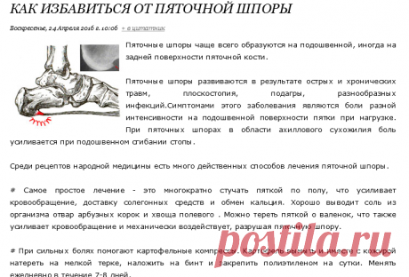 КАК ИЗБАВИТЬСЯ ОТ ПЯТОЧНОЙ ШПОРЫ