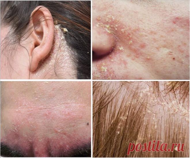 Себорейный дерматит. Симптомы и лечение.→ LIFETY.RU ←