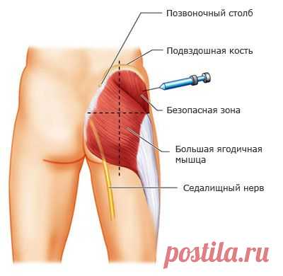 Внутримышечная инъекция в ягодицу: учимся делать самостоятельно — Делимся советами