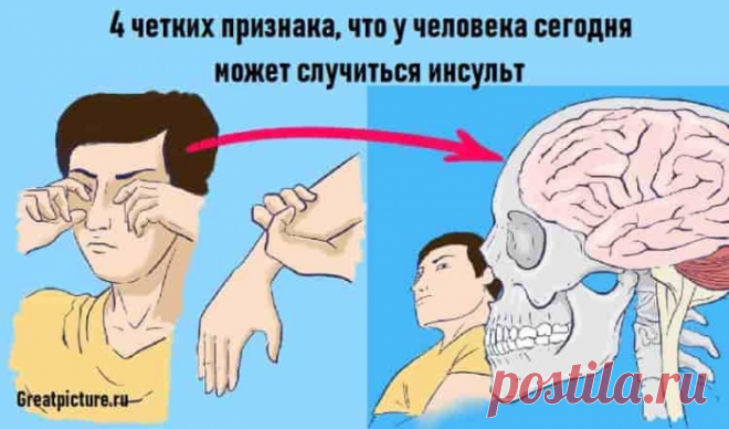 4 признака, что у человека сегодня может случиться инсульт