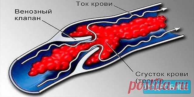 Не хочешь тромбов, просто пей этот коктейль - ПОЛЕЗНЫЕ СОВЕТЫ Народная медицина предлагает универсальный коктейль от многих заболеваний. Нужно смешать в одной бутылке (желательно тёмного стекла) аптечные настойки: