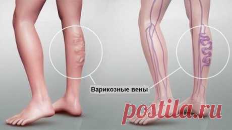 Этот метод поможет избавиться от проблем с кровообращением всего за 30 минут! » Страница 2 » ЧапЧап