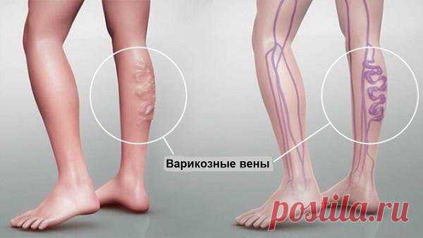 Этот метод поможет избавиться от проблем с кровообращением всего за 30 минут! » Страница 2 » ЧапЧап