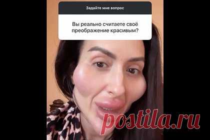 Украинка с самыми большими щеками в мире высказалась о своей красоте