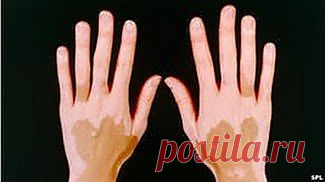 Помощь при витилиго | Друг пенсионера
Я знаю, что многие люди страдают кожным заболеванием вити­лиго, и хочу поделиться рецептами, которые нашла в книгах, посвященных использованию растений в домаш­ней косметике и дерматологии.