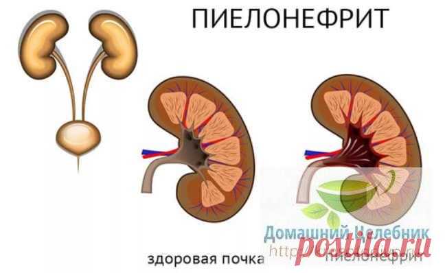 Пиелонефрит - как лечить по назначению врача и народными методами. Жить без боли!