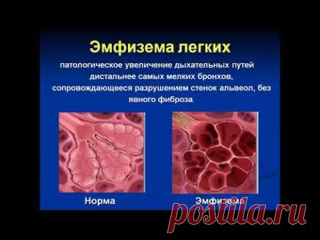 Хроническая обструктивная болезнь легких (ХОБЛ)