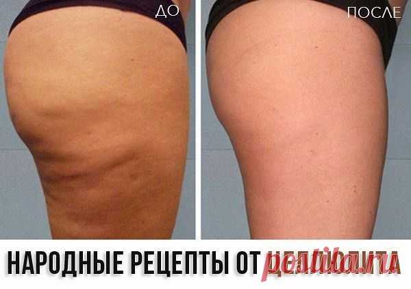 Избавляемся от целлюлита!.