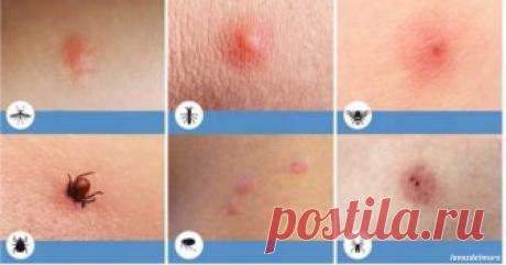 8 типов укусов насекомых, о которых вы просто обязаны знать! 
Особенно, если у вас есть дети.

Весной и летом во время вылазок на природу и прямо дома нас всех часто кусают какие-то насекомые. Чтобы избежать непредвиденных и неприятных последствий, очень важно …
