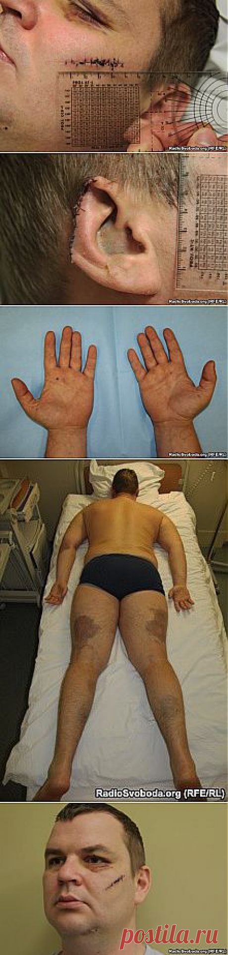 Опубликованы фотографии Дмитрия Булатова со следами пыток | Происшествия | АиФ Украина