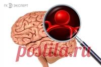 «Бомба замедленного действия». Говорим об аневризме сосудов головного мозга Это заболевание может протекать бессимптомно. И может осложняться кровоизлиянием в мозг.
Об аневризме сосудов головного мозга мы побеседовали с врачом-нейрохирургом «Клиника Эксперт» Воронеж Владимиром Абрамовичем Табачниковым.