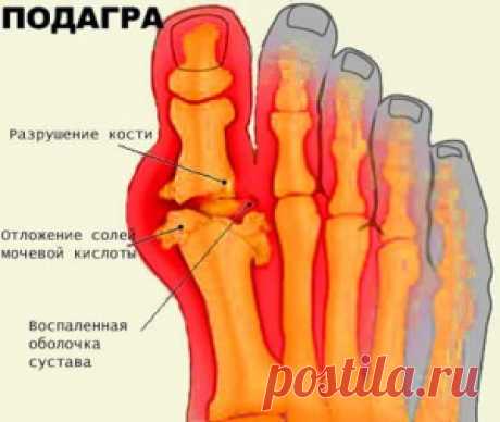Как вылечить подагру в домашних условиях народными средствами
