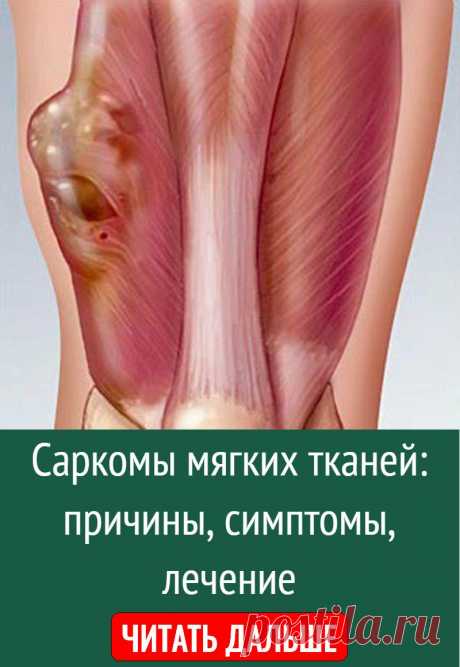 Саркомы мягких тканей: причины, симптомы, лечение