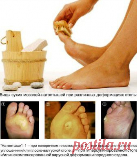 Избавляемся от натоптышей и мозолей | ВСЕГДА В ФОРМЕ!