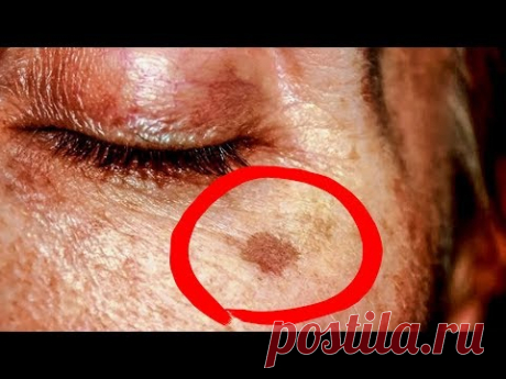 Как Удалить старческие Пятна на коже? Простой Эффективный способ. Старческая пигментация.