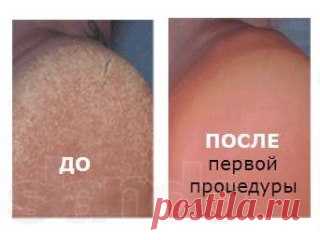 СУПЕР-СРЕДСТВО ДЛЯ ВАШИХ ПЯТОЧЕК!